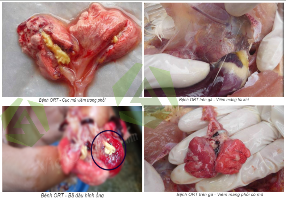 Bệnh ORT – Bệnh nhiễm trùng đường hô hấp.